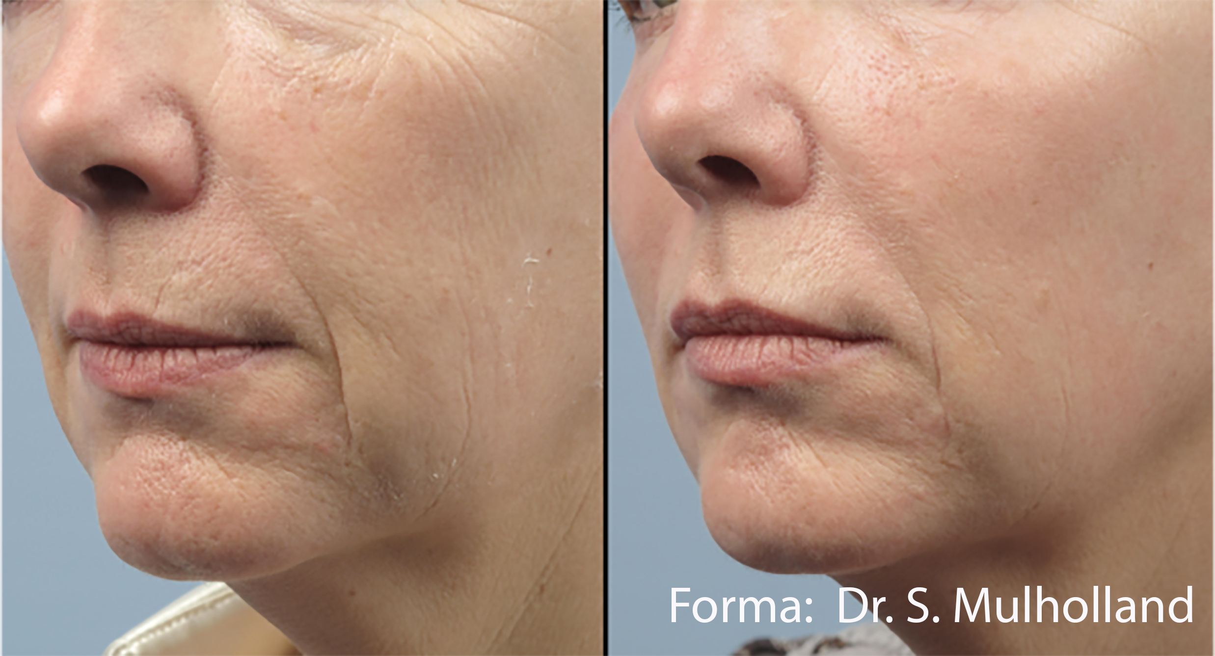 bild-hydrafacial-behandlung