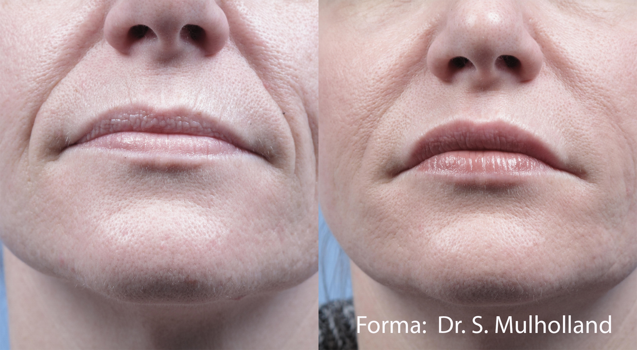 bild-hydrafacial-behandlung