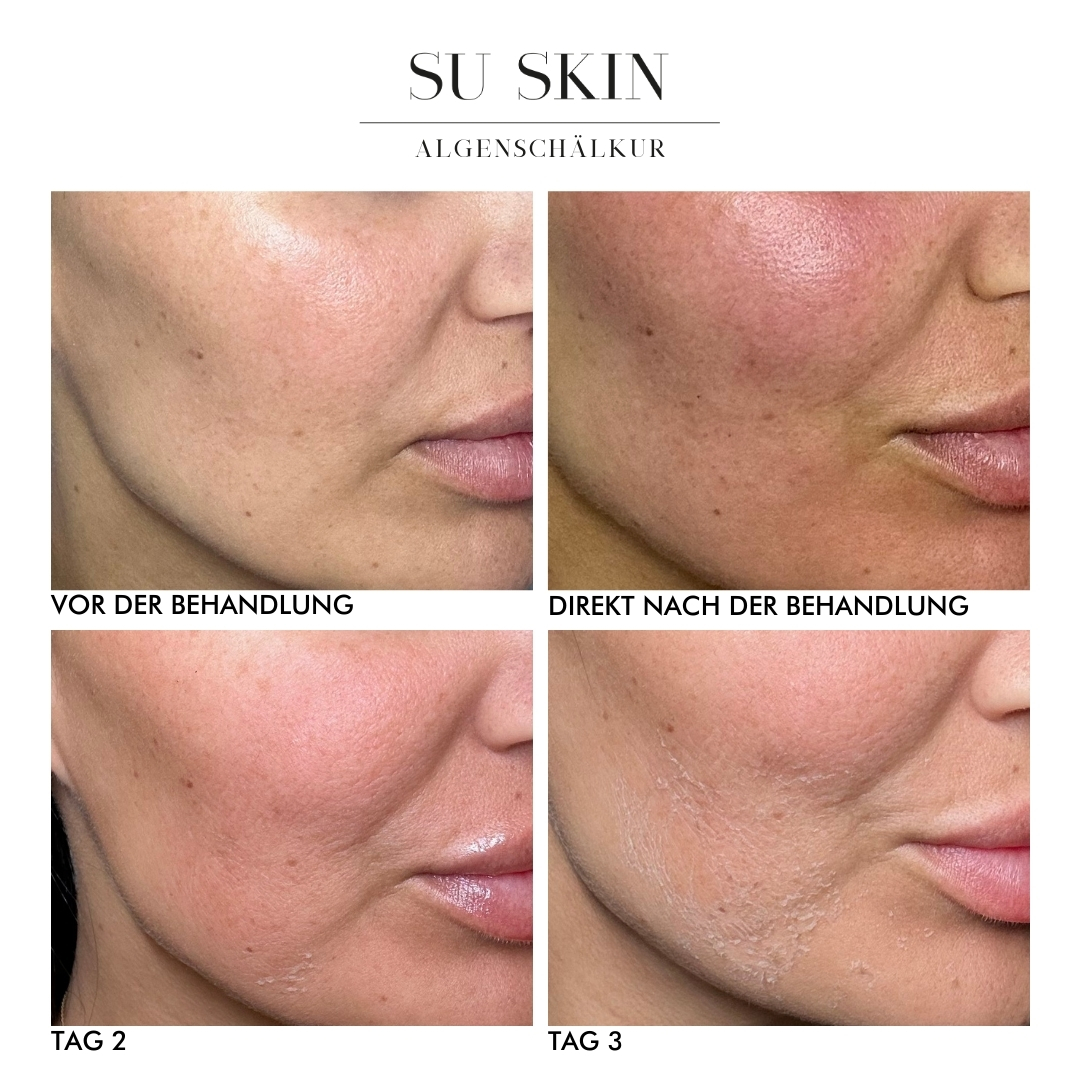 bild-bio-needling-algenschaelkur
