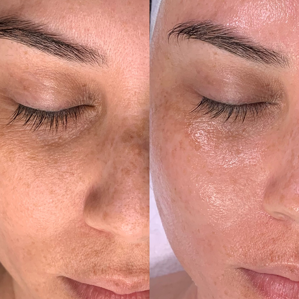 bild-hydrafacial-vorher-nachher