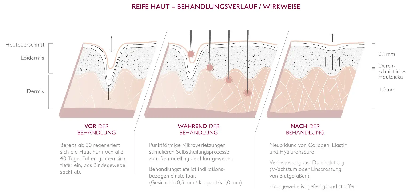 Bild Microneedling Gesichtsbehandlung